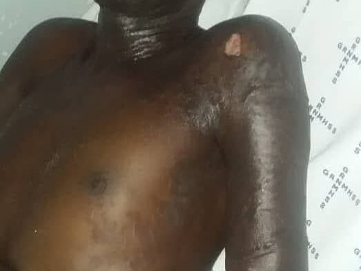 Man severely burned with cooking oil by wife