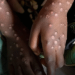 Namibia Confirms First Mpox Case in Swakopmund