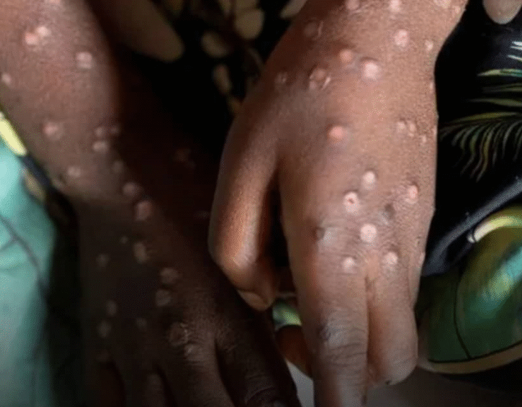 Namibia Confirms First Mpox Case in Swakopmund