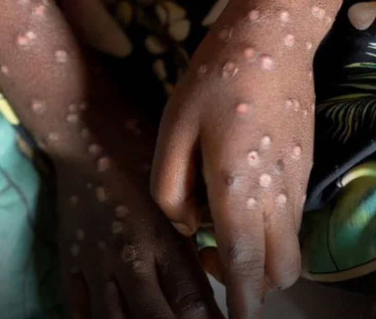 Namibia Confirms First Mpox Case in Swakopmund