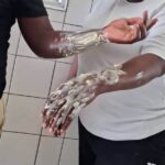 Kitchen Workers Burned at Oshakati State Hospital Amid Equipment Neglect