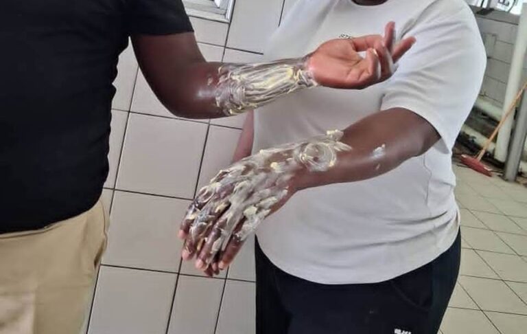 Kitchen Workers Burned at Oshakati State Hospital Amid Equipment Neglect 7 FB IMG 1759386996160 1
