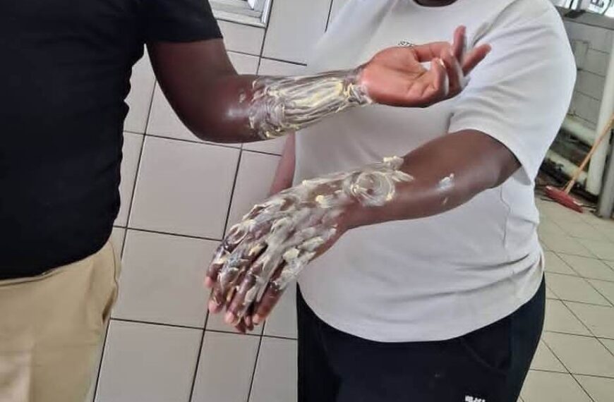 Kitchen Workers Burned at Oshakati State Hospital Amid Equipment Neglect