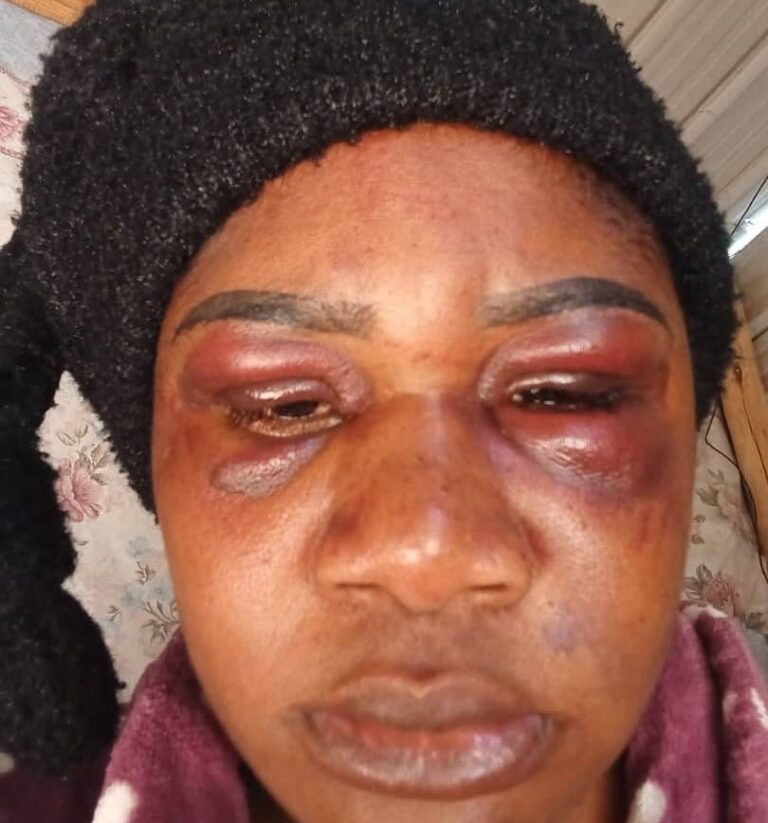 Woman Recalls How She Was Robbed of Over N$12,000 and Beaten by Men Posing as Taxi Drivers 5 FB IMG 17602821164692