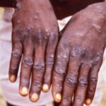 Mpox Cases Rise to 44 Along Namibia’s Coast towns