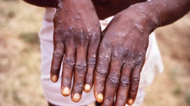 44 Individuals in Walvis Bay and Swakopmund Identified Through Mpox Contact Tracing 6 Mpox Cases