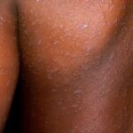 Measles Outbreak Hits 198 Cases in Namibia
