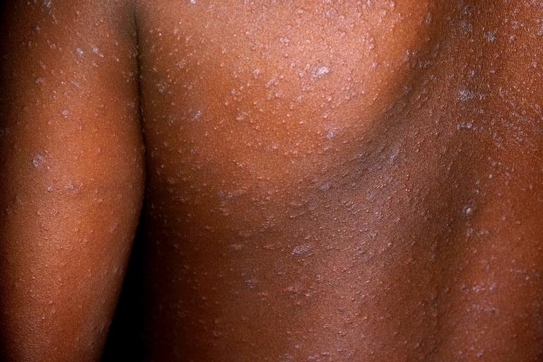 Measles Outbreak Hits 198 Cases in Namibia 1 1000672190